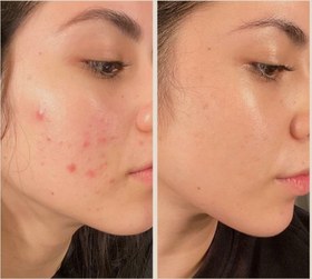 تصویر ضدجوش فوری 