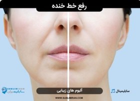 تصویر رفع خط خنده 