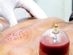 تصویر حجامت درمانی 