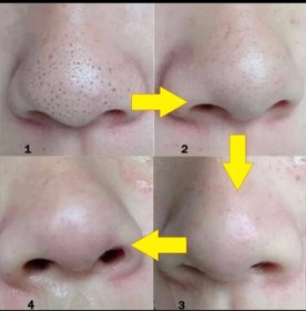 تصویر چسب لایه بردار بینی Nose strips