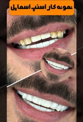 تصویر لمینت دندان دو فک اصلی برای خرابی 10 دندان vision10 دکترفروش 