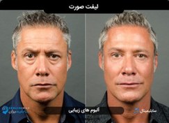 تصویر سابلیمینال لیفت صورت 