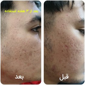 تصویر کرم چاله و گودی جای آبله و جوش 