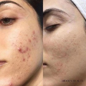 تصویر آموزش،دوره آلگاپیلینگ اسپیکیول تراپی تکنیک پوست مار Spicul Theraph Alga peeling