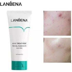 تصویر فوم شستشوی صورت ضد جوش برند لانبنا Lanbena Acne Treatment Facial Cleanser