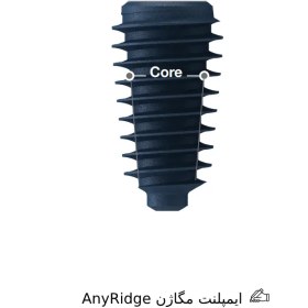 تصویر ایمپلنت AnyRidge مگاژن 