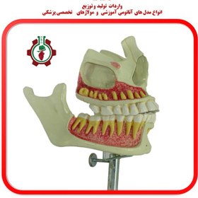 تصویر مولاژ فک و دندان Mollage of the jaw and teeth