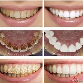 تصویر قطره سفید کننده و جرم گیر دندان لانبنا LANBENA LANBENA teeth whitening and descaling drops