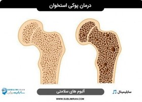 تصویر کمک به درمان پوکی استخوان حاد یا خفیف 