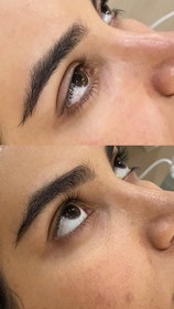 تصویر پکیج دور چشم 