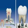 تصویر مدل (مولاژ) اولین دندان آسیاب فک تحتانی 