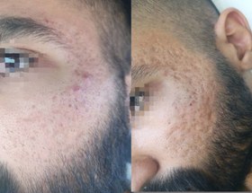 تصویر سرم نیاسینامید 