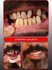 تصویر لمینت دندان دو فک اصلی برای خرابی 4 دندان vision 4 دکترفروش 