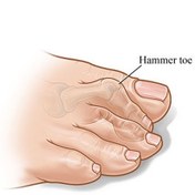 تصویر لاانگشتی هَمِر تو طب و صنعت مدل 10800 ا Hammer Toe Separator, 10800 Hammer Toe Separator, 10800