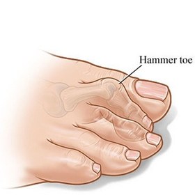 تصویر لاانگشتی هَمِر تو طب و صنعت مدل 10800 ا Hammer Toe Separator, 10800 Hammer Toe Separator, 10800