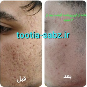 تصویر کرم چاله و گودی جای جوش و آبله و بخیه 