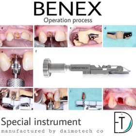 تصویر کیت استخراج حرفه ای ریشه دندان Benex نسخه پرو 