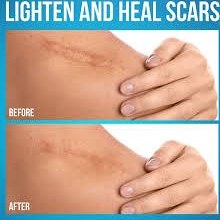 تصویر نوار نانو سیلیکون طول ۳ متر بهبود جای زخم و بخیه inkaskincare Inkaskincare