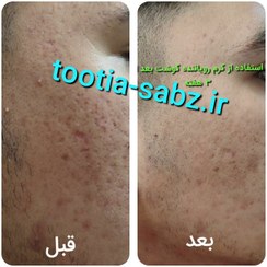 تصویر کرم پرکننده حفره و گودی جای جوش و زخم و بخیه 