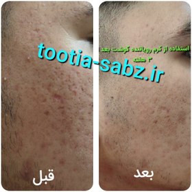 تصویر کرم جای جوش ( رفع گودی و چاله و حفره جای جوش و بخیه ) 