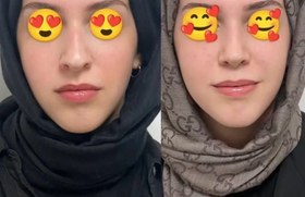 تصویر لیفت کننده و کوچک کننده بینی لاکچری کوین ۴۰ میل با تکنولوژی فرانسه اورجینال 