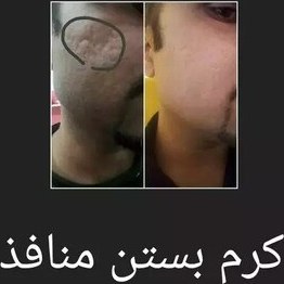 تصویر کرم قیروط پرکننده منافذبازصورت رفع چاله وچوله صورت جای زخم سالک اصل 