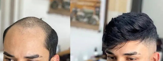 تصویر پروتز مو بالا سر مردانه لس آنجلسی دور پوست موی طبیعی کد 1101 