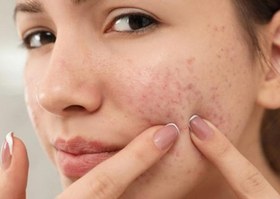 تصویر ضدجوش فوری 