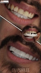 تصویر لمینت دندان Snap On Smile برای خرابی ۲ دندان 