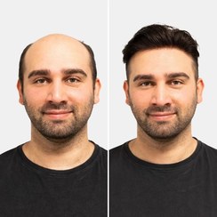 تصویر کلاه گیس مردانه پروتز مو طبیعی مدل هالیوودی VIP کد ۱۸۲ 