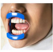 تصویر دهان باز کن ویژه بیلیچینگ-سامان زر دندان 