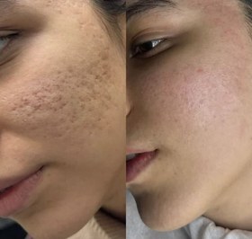 تصویر سرم نیاسینامید 