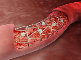 تصویر استنت پریفرال 6فرنچ اگزیست - QMEDICS / 5-7*60/80/100 / 3305000 تومان Stent Pripheral QMEDICS