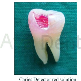 تصویر شناساگر پوسیدگی دندان مروابن Caries Detector