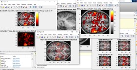 تصویر تشخیص و دسته بندی داده های تومور های مغزی با روش fmri در متلب :پروژه متلب 