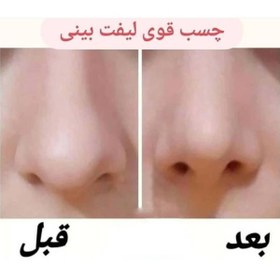 تصویر چسب لیفت بینی دورنیکا ا Dornika transpare pe tape Dornika transpare pe tape