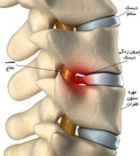 تصویر دانلود پاورپوینت درباره دیسک کمر 