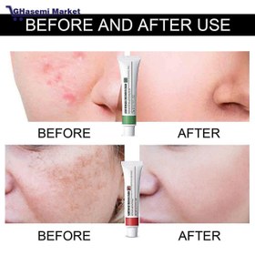 تصویر کرم ضد جوش ایلهو EELHOE Acne Removal Treatment Cream