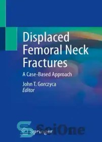 تصویر دانلود کتاب Displaced Femoral Neck Fractures: A Case-Based Approach - شکستگی های جابجا شده گردن فمور: یک رویکرد مبتنی بر مورد 