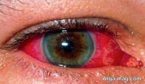 تصویر خون مخصوص چشم 