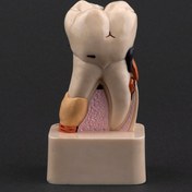 تصویر مدل نمایشی پاتولوژی دندان 