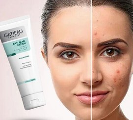 تصویر کرم ژل آنتی آکنه (ضدجوش و ضد لک) گاتیو Anti Acne Cream