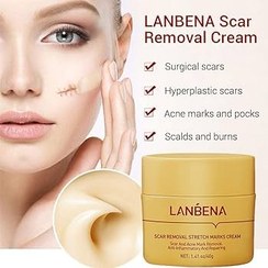 تصویر کرم کاسه ای رفع اسکار و استرچ لانبنا 40 میل lanbena scar removal stretch marks cream