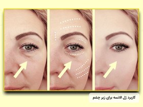 تصویر ژل فیلر الانسه مدل M دو ساله Ellanse Filler M 2 Year