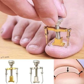 تصویر ارتودنسی ناخن فلزی 