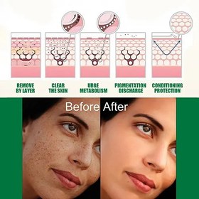 تصویر سرم درمان جوش و آکنه ایلهو EELHOE اورجینال Original EELHOE anti-pimple and acne serum treatment Original EELHOE anti-pimple and acne serum treatment