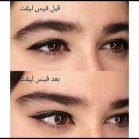 تصویر کش لیفت شقیقه 