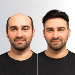 تصویر پروتز مو دور سیلیکون فاین مونو | مردانه درجه b 