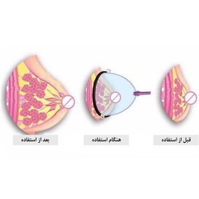 تصویر وکیوم حجم دهنده سینه بانوان رفع مشکلات افتادگی و حجم دهند سینه بانوان