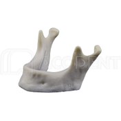 تصویر کست مندیبل آتروفی با خروجی عصب حاس 